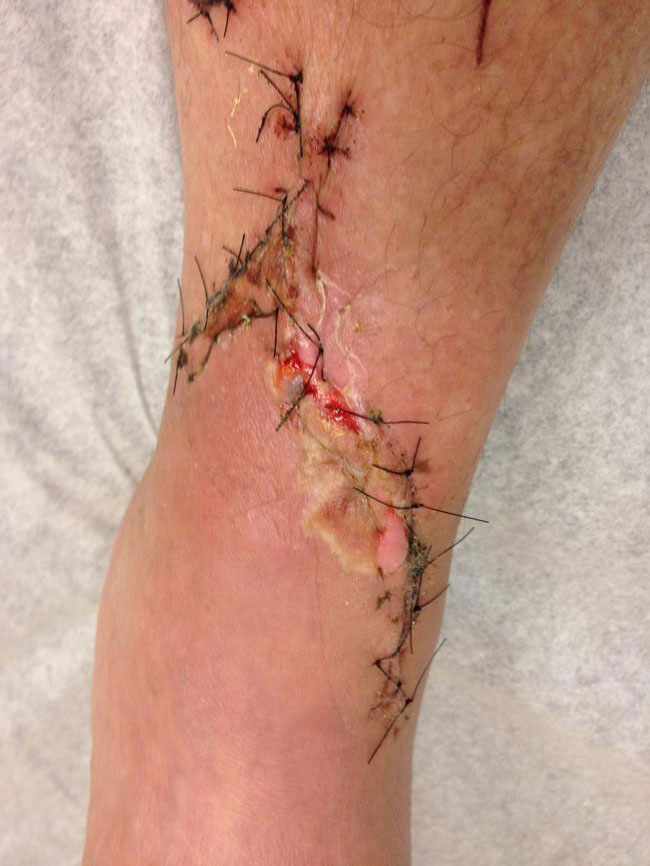 Chris’s left leg shows the damage done by a great white.