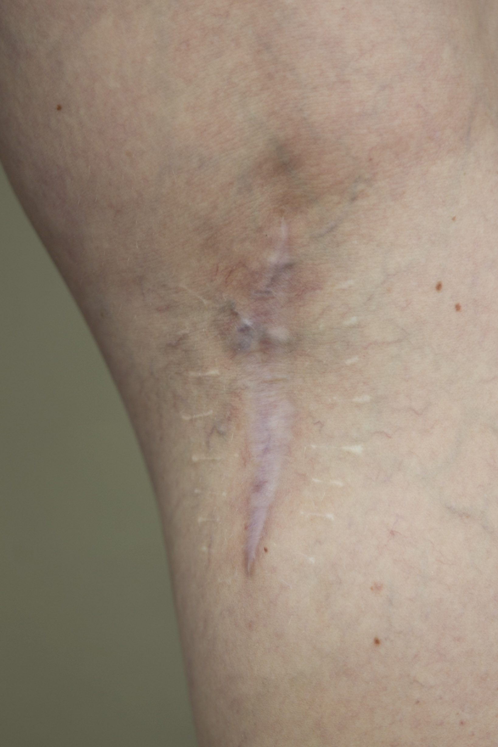 A scar on Campbell’s leg shows where her cancerous mole was removed.