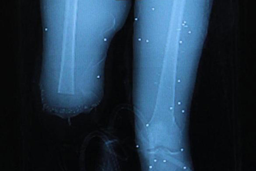 Mark Fucarile’s legs
