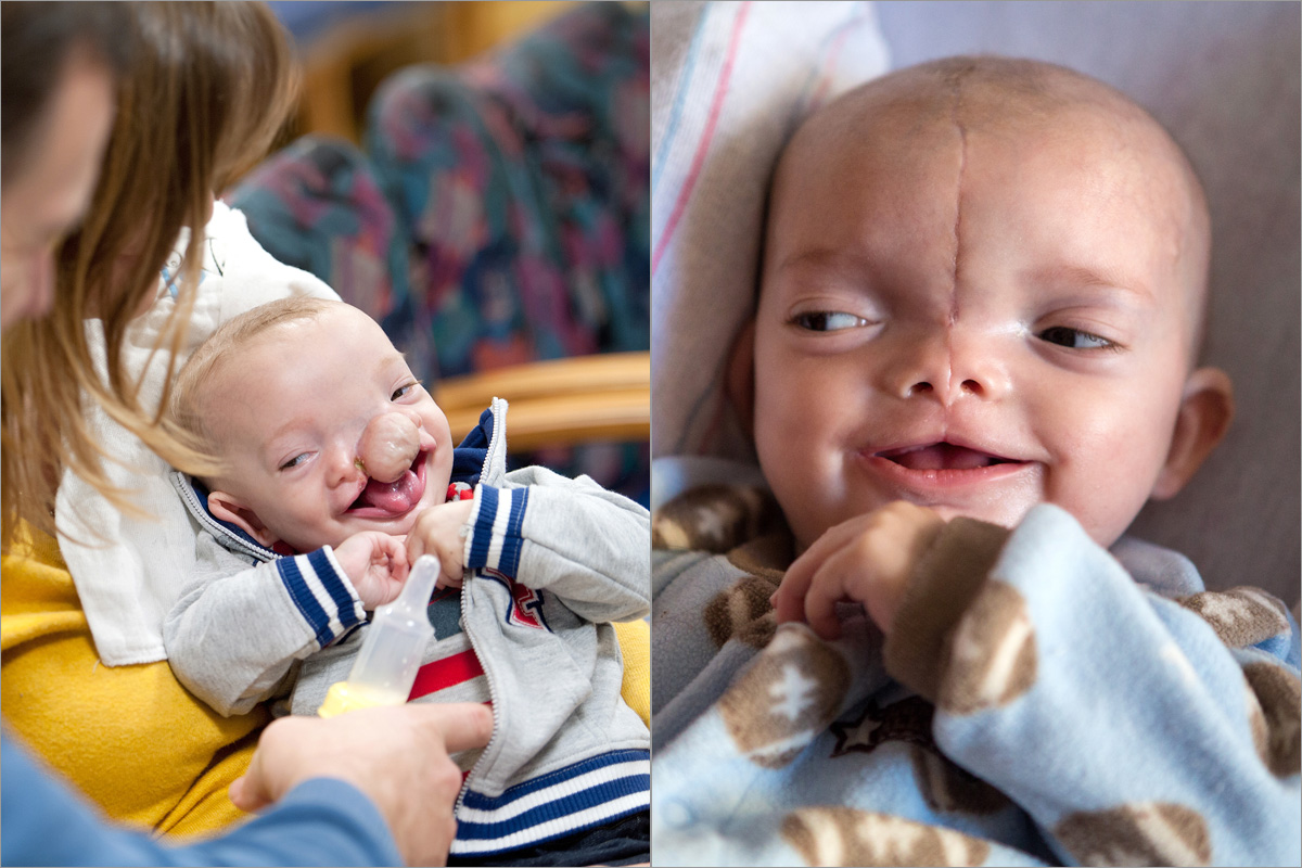 Dominic Pio Gundrum was born with a rare disorder in which part of his brain was exposed. Doctors have told Dominic’s parents that he will walk and talk.
