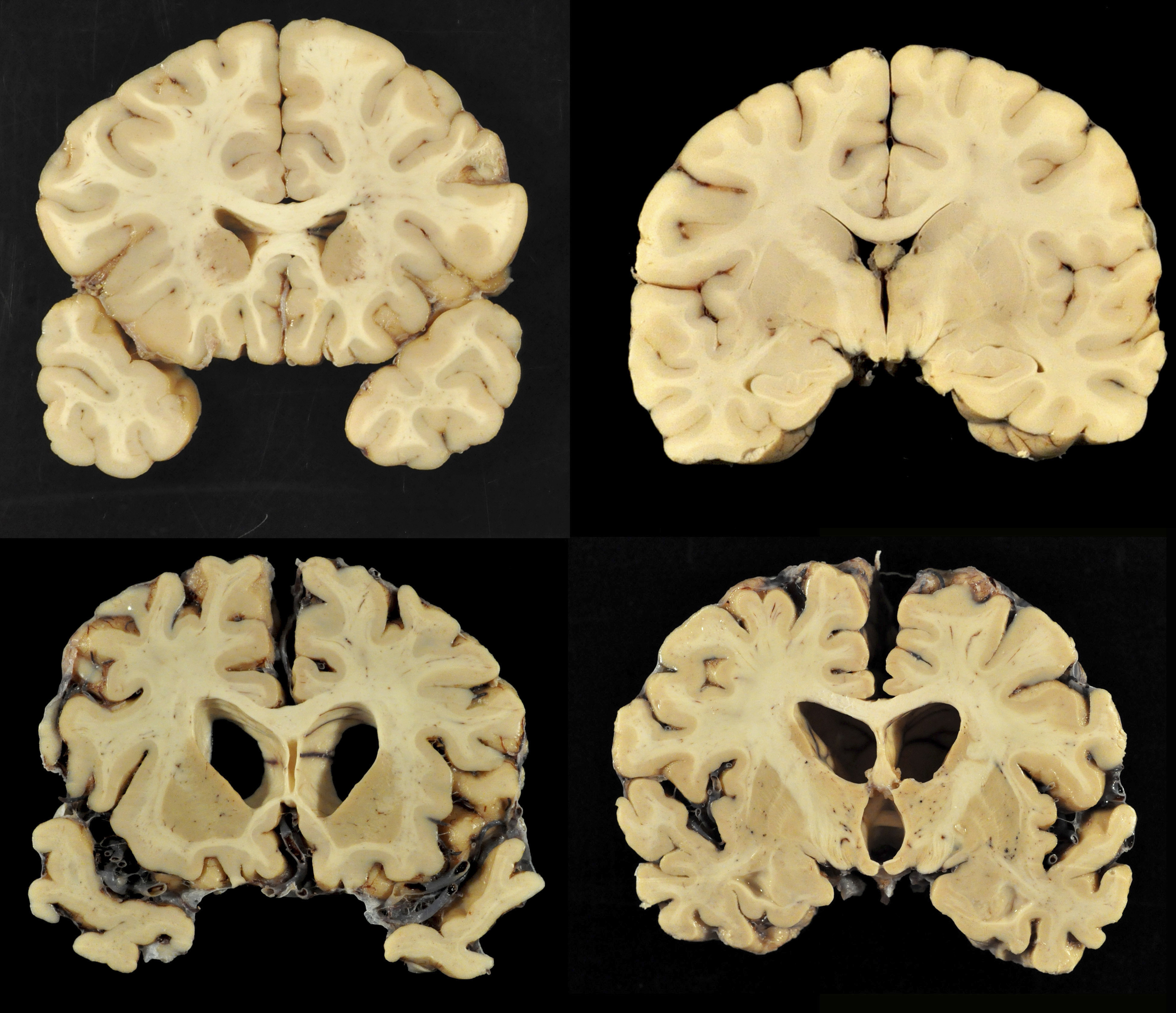 A combination of photos provided by Boston University shows sections from a normal brain (top) and from the brain of former University of Texas football player Greg Ploetz (bottom), in stage IV of chronic traumatic encephalopathy.