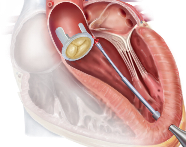 The robot catheter nears the leaky valve