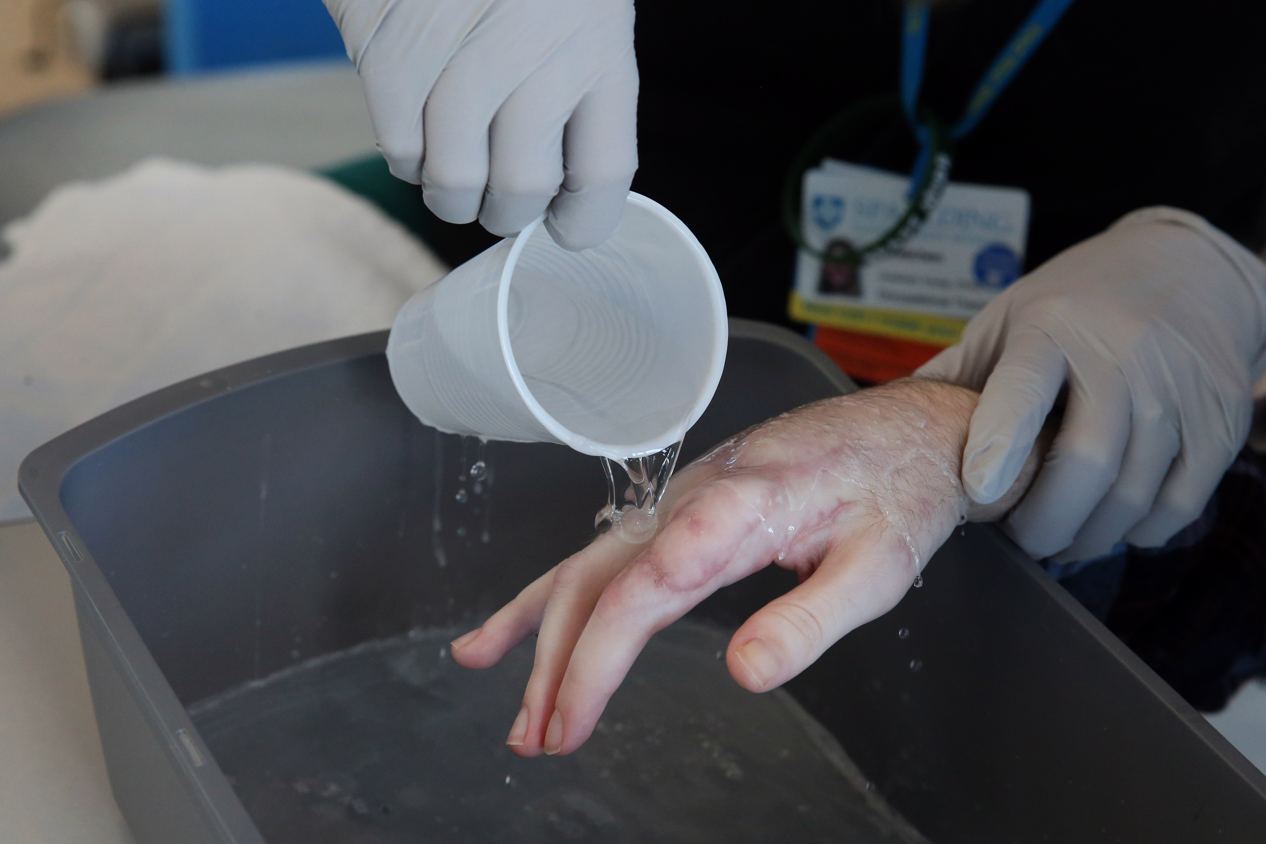 Occupational therapist Gretchen Young used a paraffin wax solution to treat Sonya at Spaulding Rehabilitation Center in Charlestown.