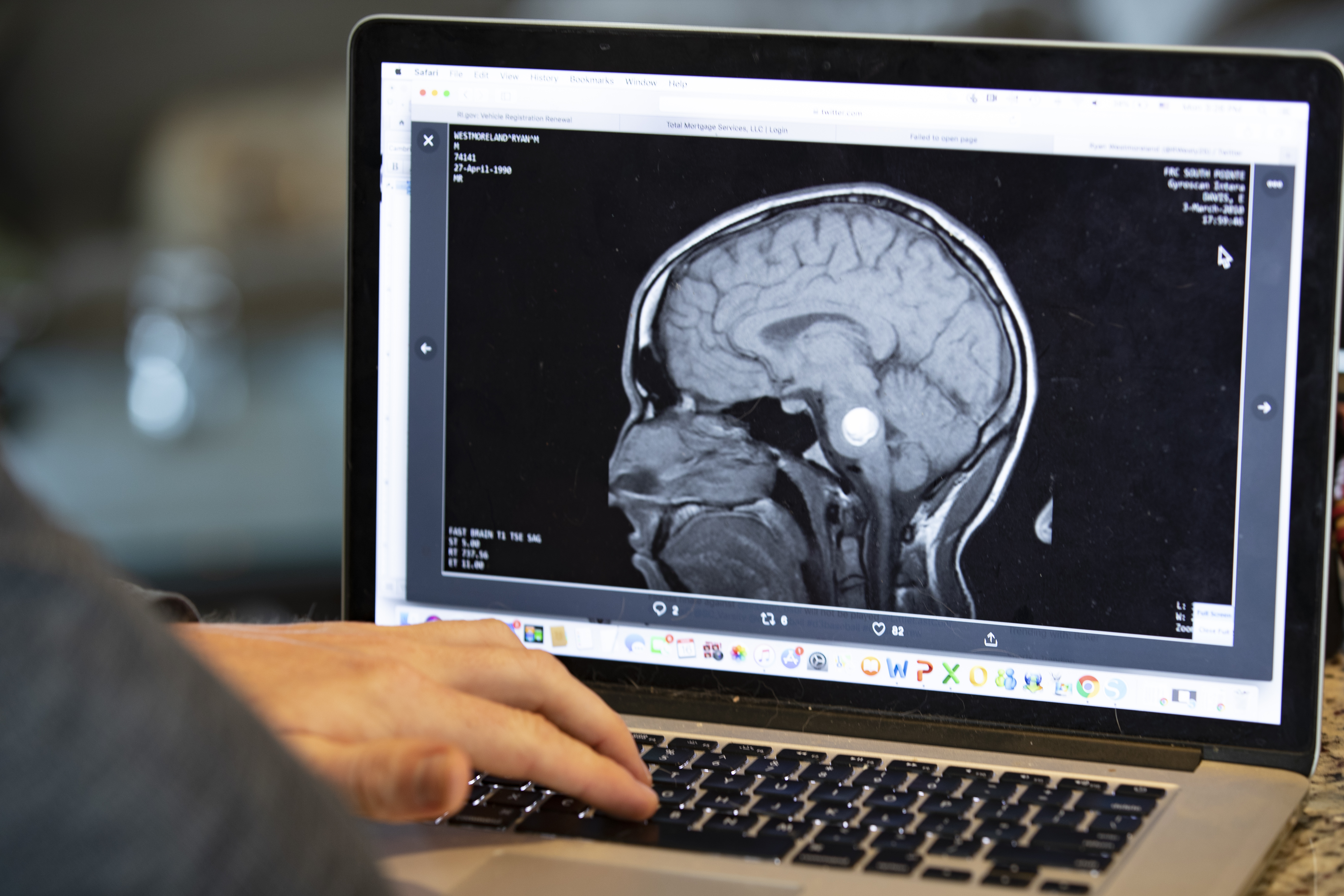 The original MRI, showing the tumor in his brain.