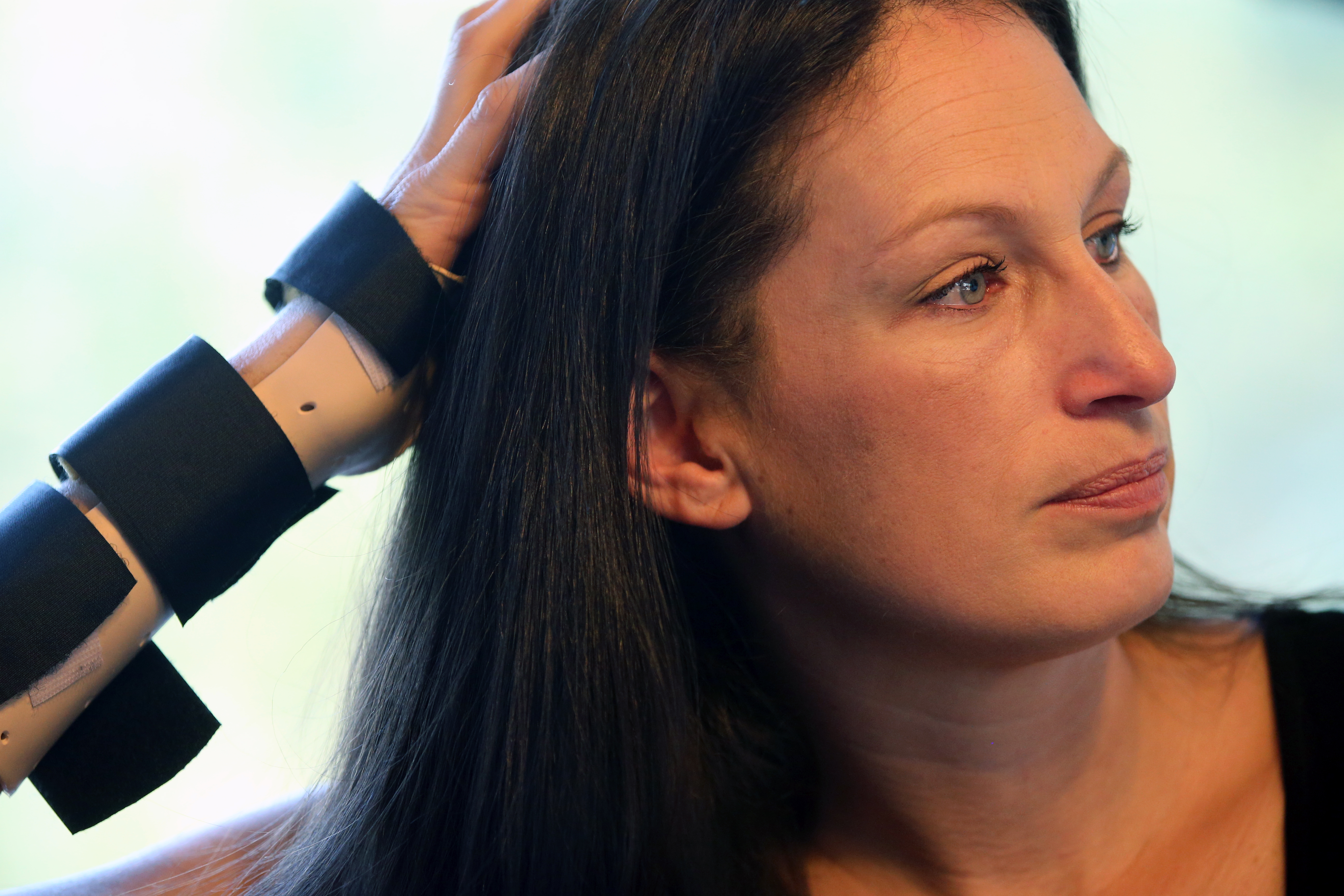 Alison Novak wore braces on her arms to keep her joints in place at her home in Johnston, R.I.