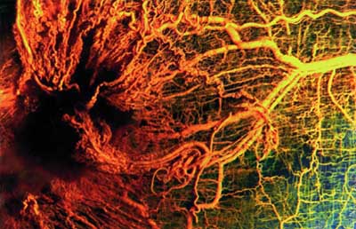 Blood vessels growing toward a tumor.