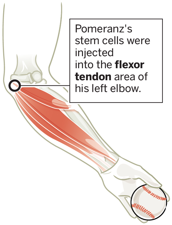 Source: Dr. Lyle Cain/Andrews Sports Medicine & Orthopedic Center