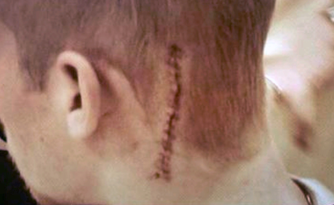 The scar from Westmoreland's first brain surgery, in 2010.