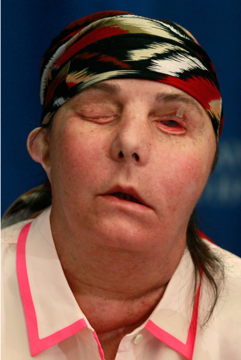 Carmen Blandin Tarleton, pictured last May — a few months after her face transplant surgery.