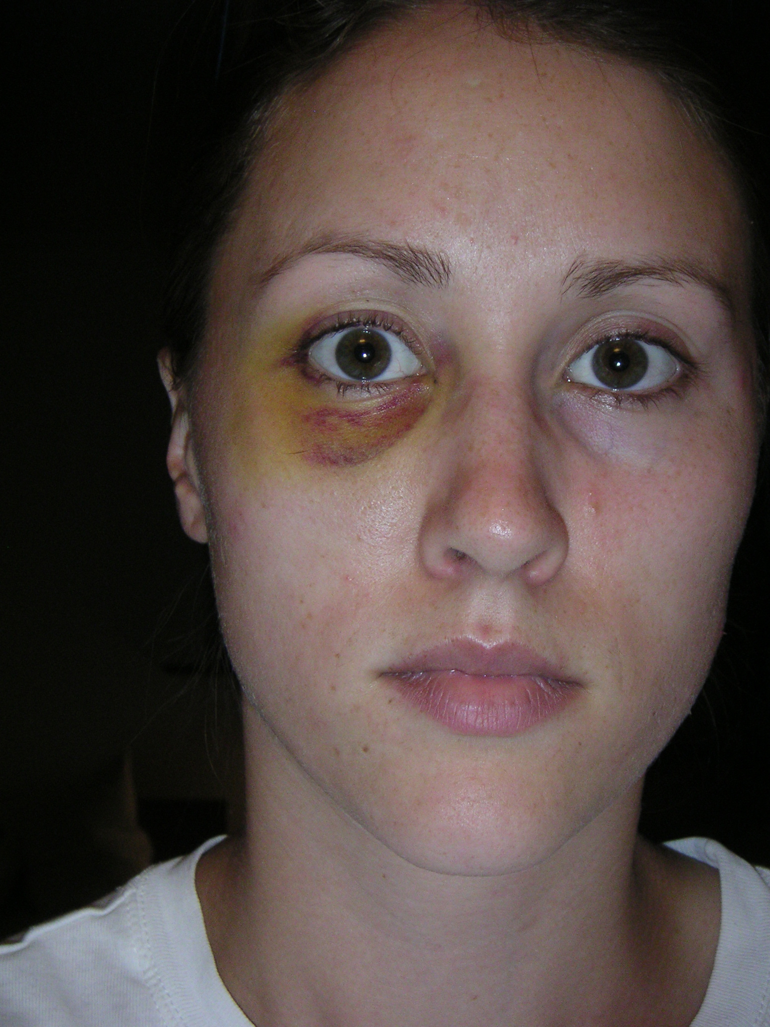 Rob Porter's ex-wife Colbie Holderness is pictured in a photo from 2005, when she says Porter gave her a black eye on an Italy trip.