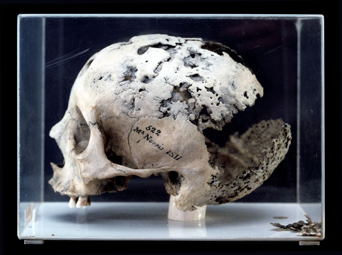 Skull in the Hunterian Museum.