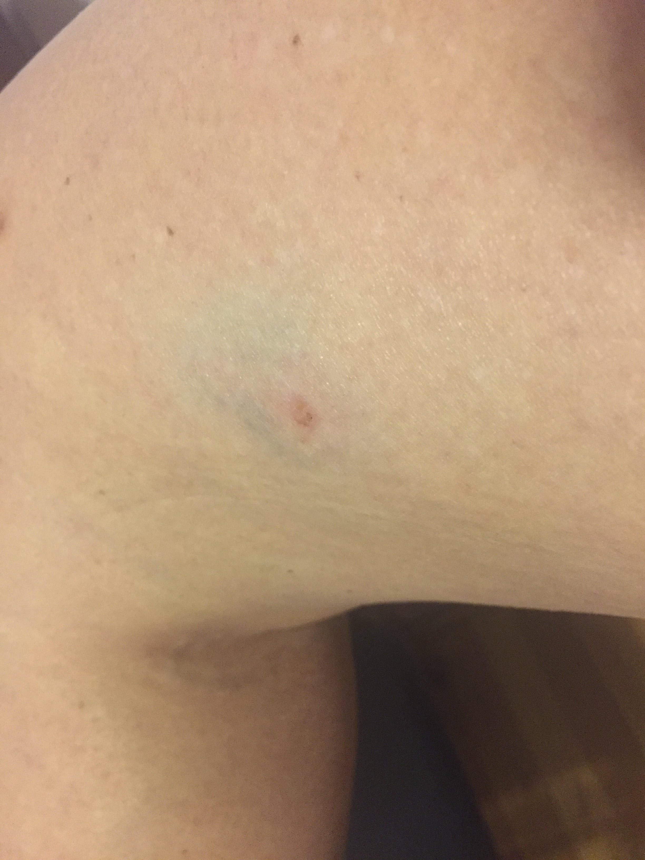 Cambridge resident Kenda Carlson says she was attacked by a group of five to six turkeys. The birds left welts and bruises on her legs.