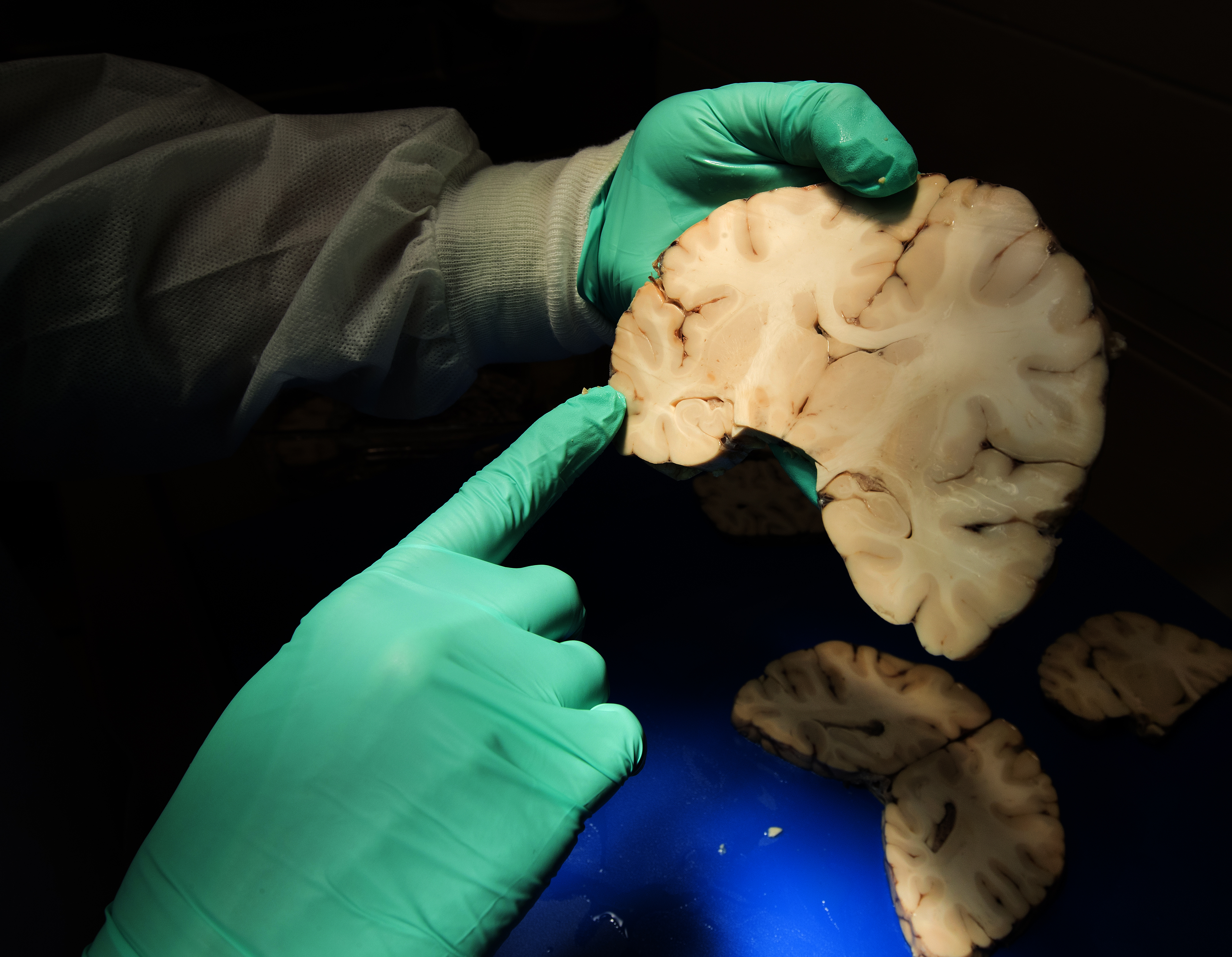 Mgh Study Suggests Genetic Link In >> Bu Researchers Make First Link From Severe Cte To Genes The Boston Mgh Study Suggests Genetic Link In >> Bu Researchers Make First Link From Severe Cte To Genes The Boston