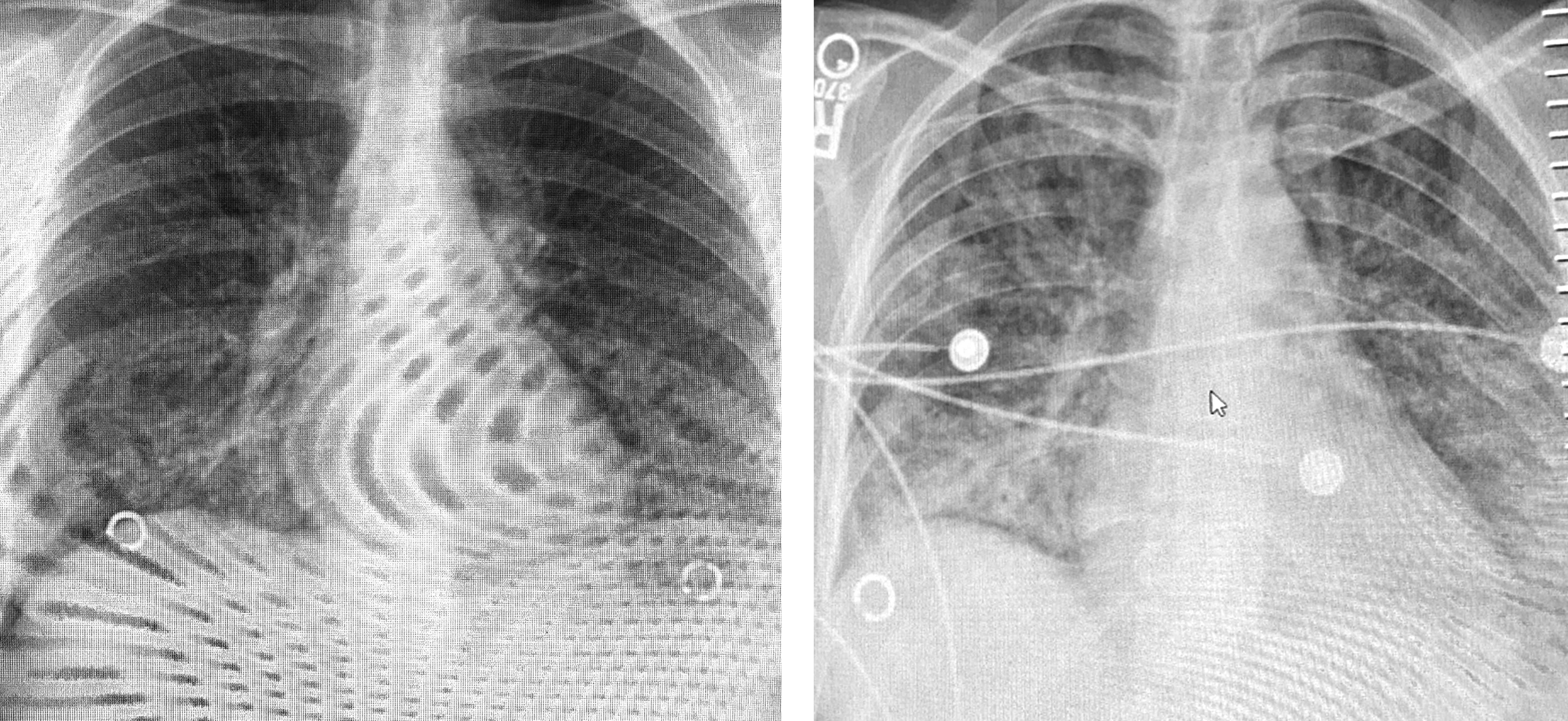 Chest scans taken Dec. 3, left, and Dec. 11, right, show evidence of the progression of her lung injuries, which are visible as the white wisps and blobs along the ribs that, in a healthy person, would appear opaque black.