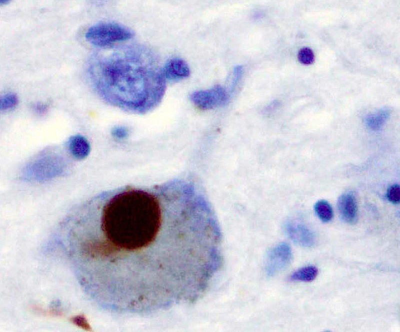 Scientists are working on targeting Lewy bodies, which are deformed clumps of protein associated with Parkinson’s.