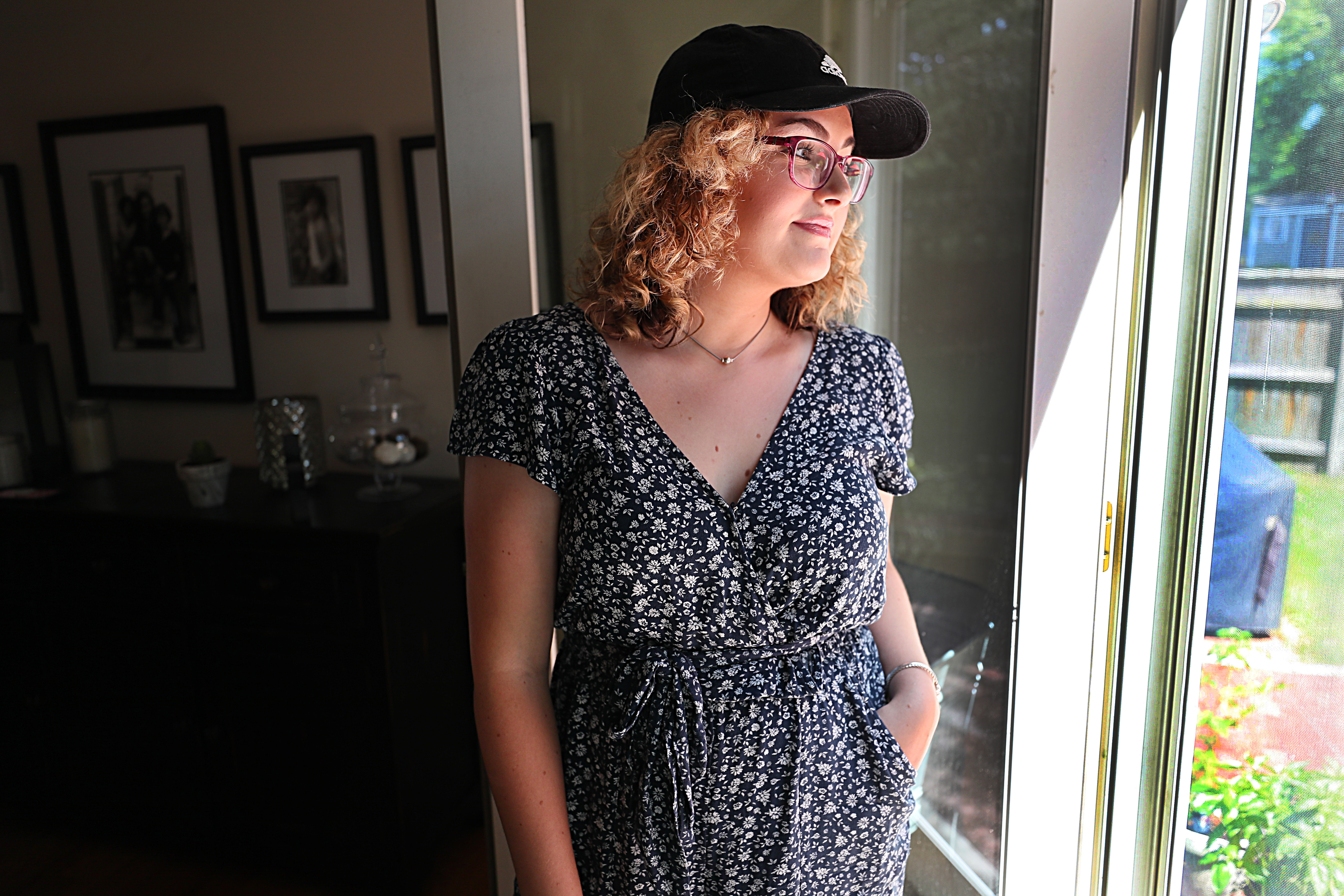 Emma Paven, 19, has sunflower syndrome.