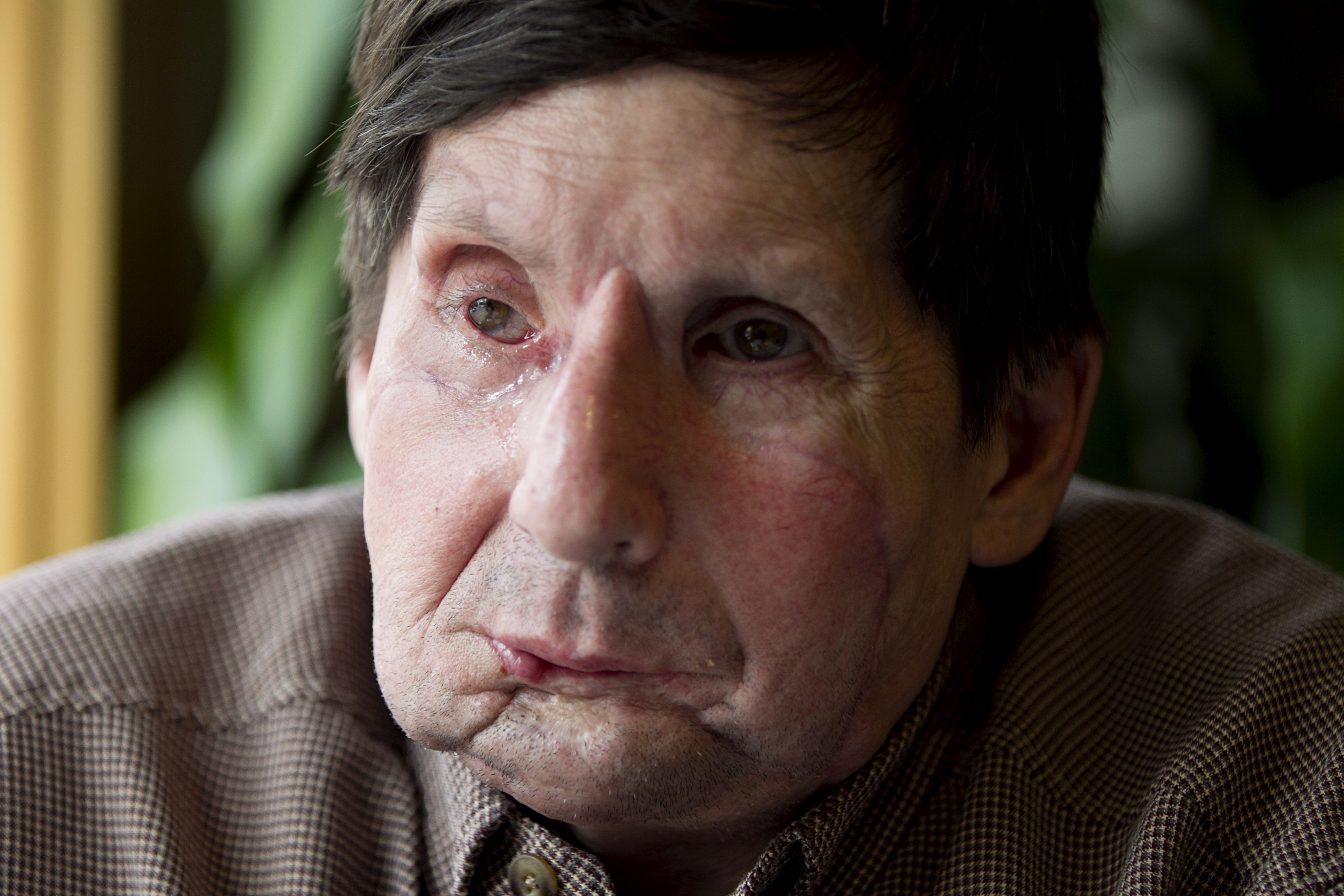 Jim Maki in 2011 — nearly two years after face transplant surgery.