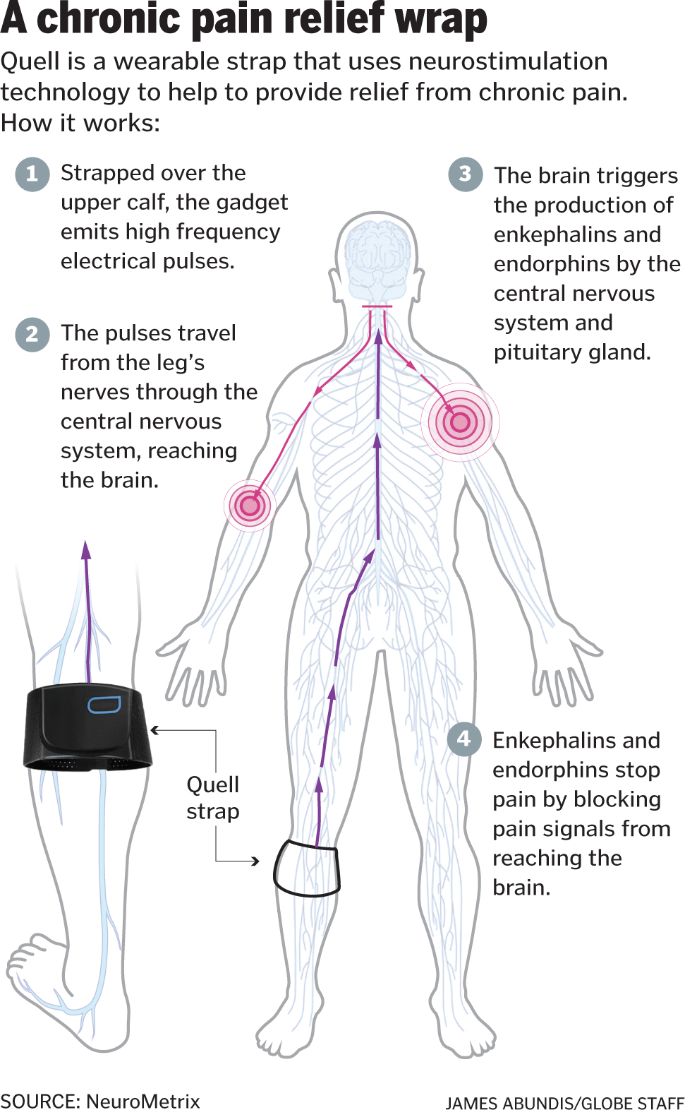 Treating pain with pulses, not drugs - The Boston Globe