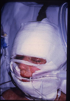 Samantha Reckis, shown in an undated photo, was hospitalized for months after a severe reaction to Children's Motrin.