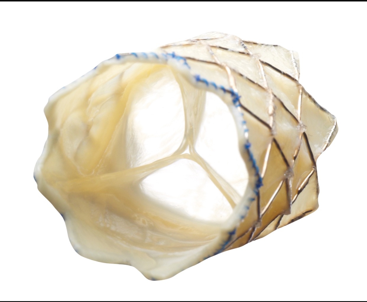 Doctors made whole Milana Foligno’s heart by inserting this tiny stent.