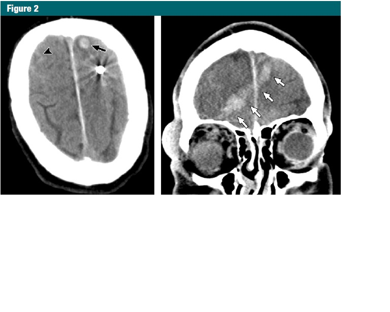 Eric Whalley’s brain scan